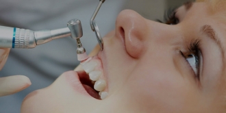 Не тільки заради краси: зубні камені треба обов’язково видаляти
